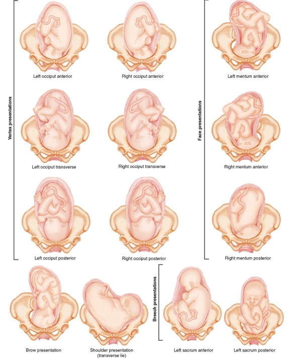Baby positioning techniques for optimal birth - Spinning Babies NYC